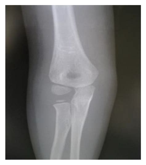 Plain X Rays Of The Right Elbow There Is No Sign Of Osteolysis A