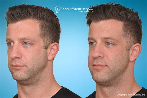 In the article below you are going to find various ways how to fix this problem. Receding Weak Chin and Small Jawline Quick Fix, No Surgery