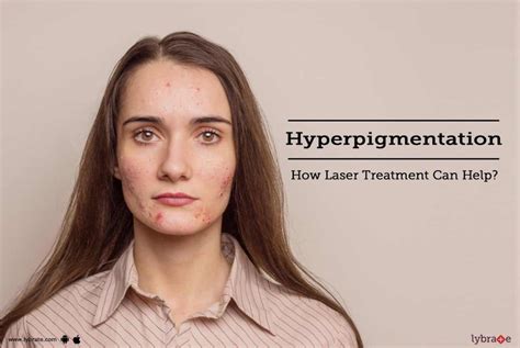 Hyperpigmentation How Laser Treatment Can Help By Dr Monica Jacob