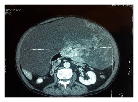 Preoperative Contrast Enhanced Abdominal Ct Scan A The Sagittal