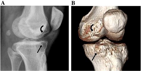 A Case Of Compression Fracture Of Medial Tibial Plateau And Medial