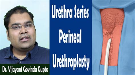 Surgery For Urethral Stricture Technique 3 Perineal Urethrostomy