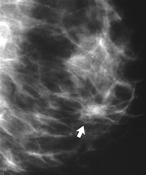 Clinical Comparison Of Full Field Digital Mammography And Screen Film