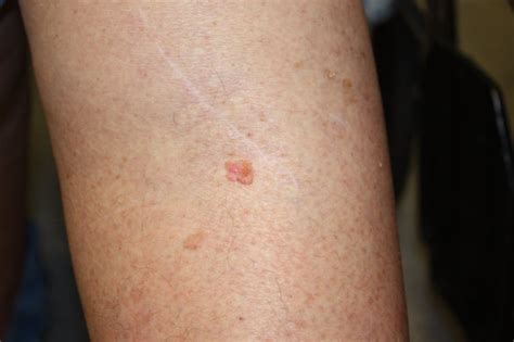 Squamous Cell Carcinoma Causes And Treatment Dermatology Consultants