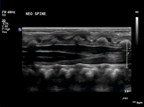 Neonatal Spine Normal Ultrasoundpaedia
