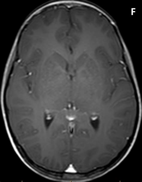 Optic Glioma Diagnosis MRI Online