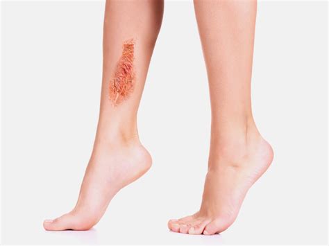 Types Causes Symptoms And Treatment Of Leg Ulcer In India Mfine