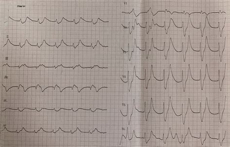 Figure From Electrocardiographic Findings In An Elderly Patient