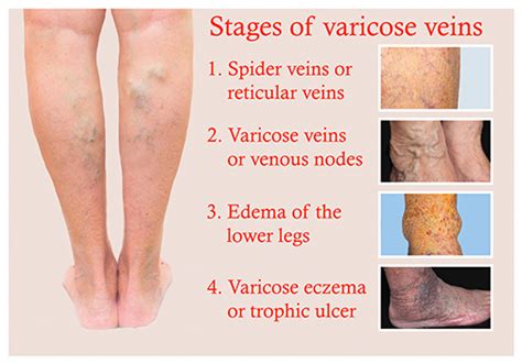 Symptoms Caused By Varicose Veins Atlanta Vascular And Vein Centers