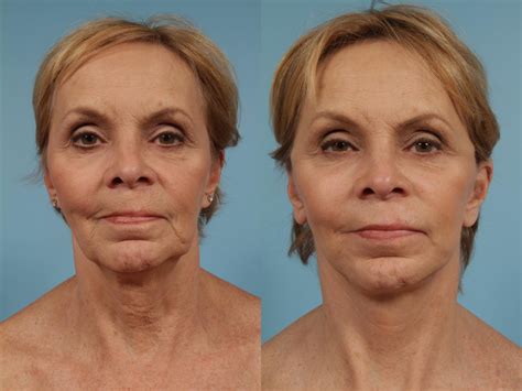 Neck Lift Before And After Photos Patient 268 Chicago Il Tlkm