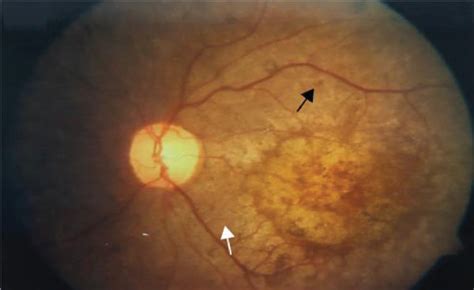 A Retina Right Reveals A Retinopathy Pigmented With Attenuated