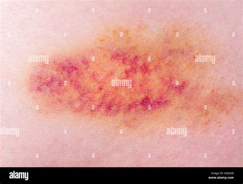 Closeup On A Bruise On Wounded Woman Leg Skin Stock Photo Alamy