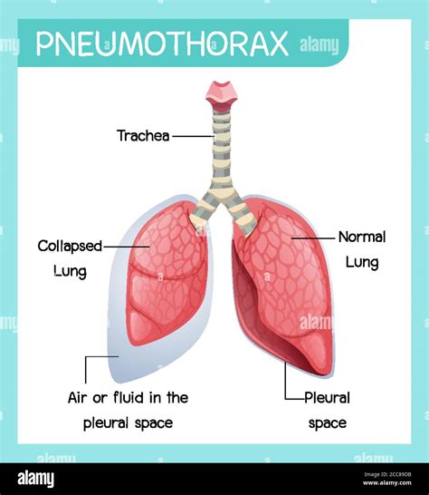 Pneumothorax Cartoon Of Human Anatomy Illustration Stock Vector Image