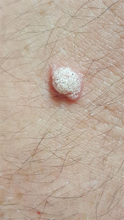 Skin Concerns Is This A Wart How Can I Treat This Rskincareaddiction