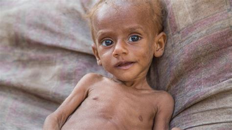 Yemen Crisis 85000 Children Dead From Malnutrition Bbc News