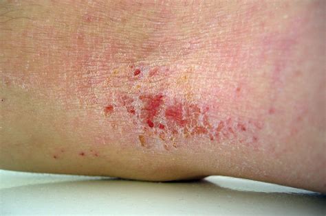 What Is Eczema Tend To Your Health