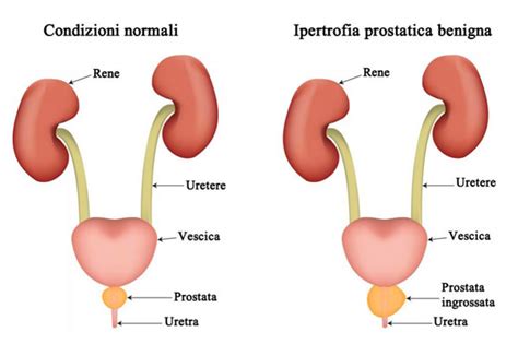 Disturbi Da Trattare Con La Riflessologia Plantare Ipertrofia Prostatica Hot Sex Picture