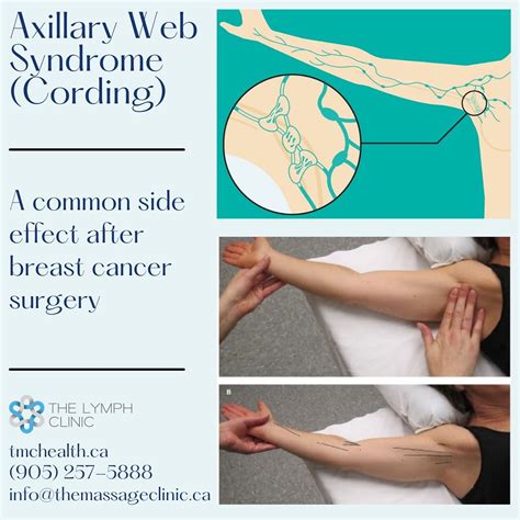 Axillary Web Syndrome Or Cording What The Lymph Clinic