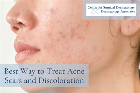 12 Best Treatments For Acne Scars And Discoloration According To Derms