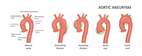 What Is Aortic Root Dilatation Showit Blog