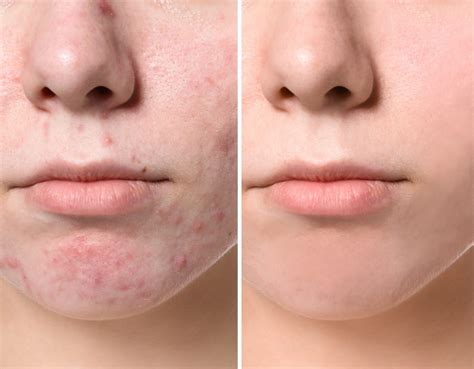 Acne Scars Removal With Pico Laser Treatment Dr Ginny Clinic