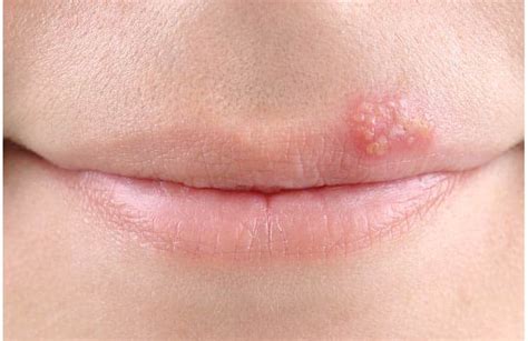 Images Of Herpes On Lips Pictures Photos