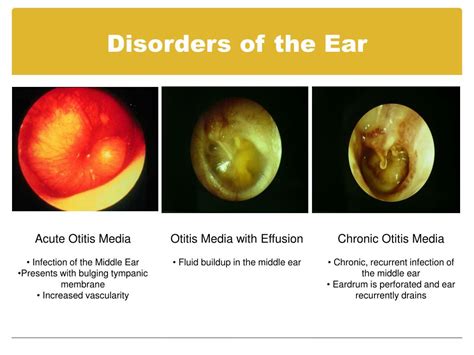 Ppt Step By Step Guide To Performing An Ear Exam Powerpoint