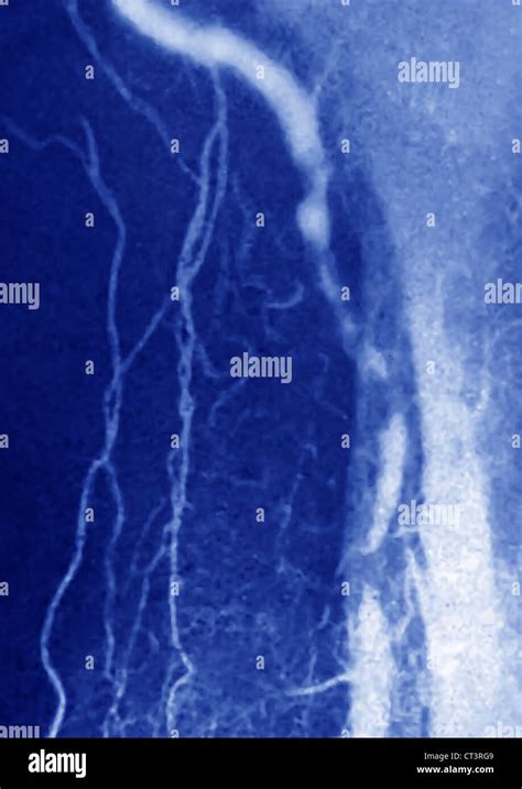 Popliteal Artery Stenosis Angio Stock Photo Alamy