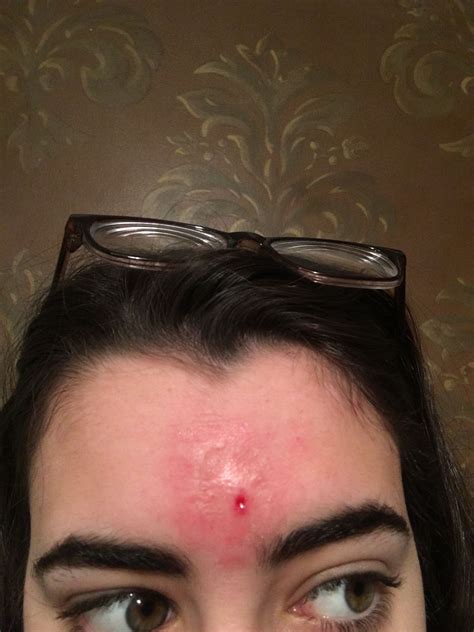 Skin Rash On Forehead Pictures