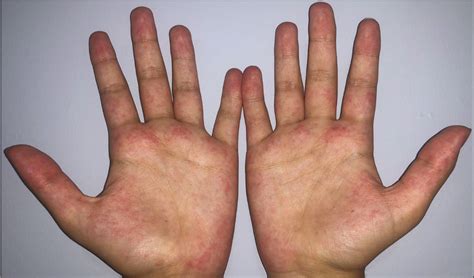 A Case Series And Literature Review Of Erythema Palmare Hereditarium