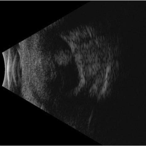 B Scan Ultrasonography Of The Left Eye Showing Microphthalmia Funnel