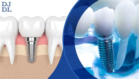 Dental Implants Everything You Need To Know Dave Johnson