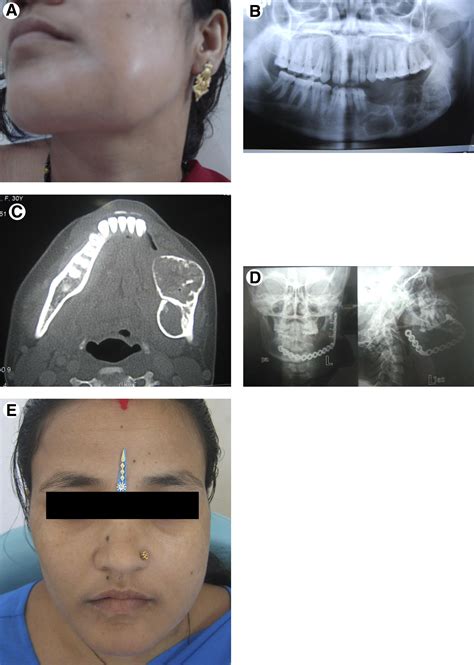 Aneurysmal Bone Cyst Of The Mandible Report Of 3 Cases Journal Of