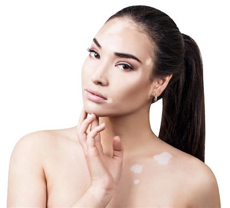 Vitiligo Treatment In Jaipur White Patches And Spots Removal Cosmo Hair