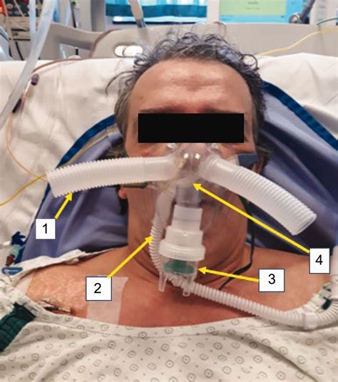 Locke et al.46 demonstrated that nc could deliver continuous distending pressure to infants and alter breathing patterns. The Double-Trunk Mask Improves Oxygenation During High-Flow Nasal Cannula Therapy for Acute ...