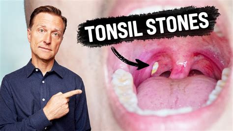 What Causes Tonsil Stones And How To Prevent Them Youtube