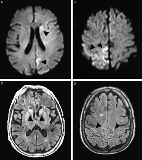 Brain Magnetic Resonance Imaging Findings In 3 Patients With Sporadic