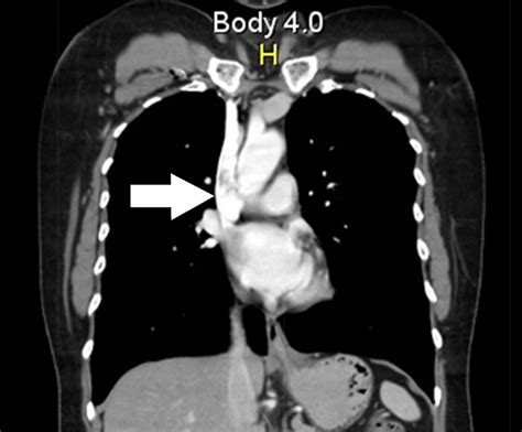 Chest Ct Showing The Thrombus In The Superior Vena Cava Download