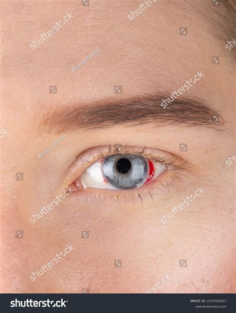 Young Woman Burst Blood Vessel Eye Stock Photo 2141562653 Shutterstock