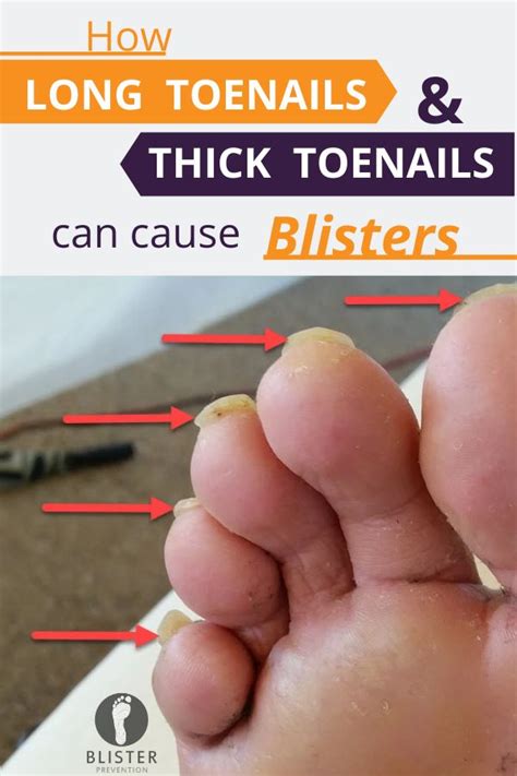 Pre Race Toenail Care For Runners Lesson 1 From Adelaide 2019 Thick