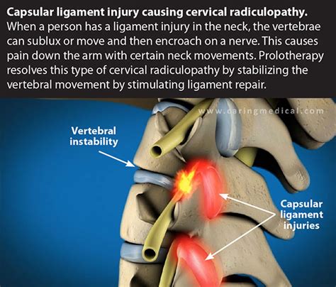 The Evidence For Non Surgical Cervical Radiculopathy Treatments
