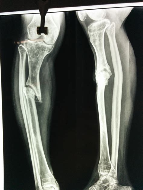 Fractures Of The Proximal Third Tibia Treated With In Vrogue Co