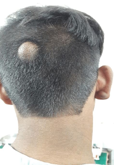 Epidermoid Cyst Scalp