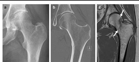 Computed Tomography For Occult Fractures Of The Proximal Femur Pelvis