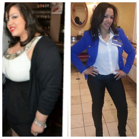 Gastric Surgery Before And After Pictures Gastric Bypass