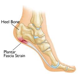 Plantar fasciitis commonly causes stabbing pain that usually. Plantar Fasciitis Treatment - Pain Is Alleviated With ...