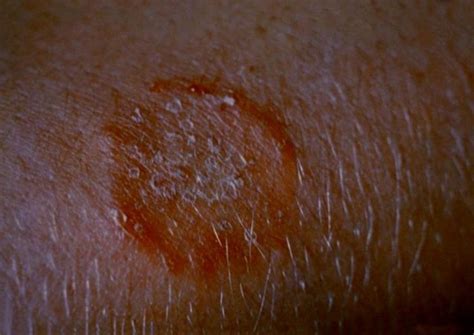 Skin Deep Home Remedies For Ringworm Home Remedies For Ringworm Get