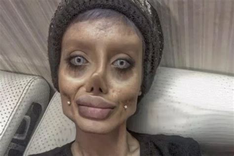 Teen Behind Viral Angelina Jolie Plastic Surgery Photos Reveals She