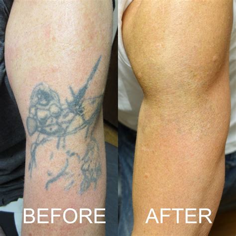 Bad Tattoos Are Rising To Utilize Tattoo Removal