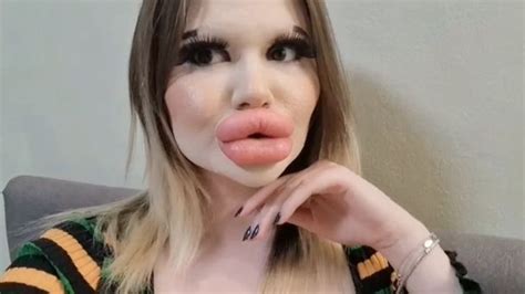 Woman With Worlds Biggest Lips Wants Huge Cheekbones Too